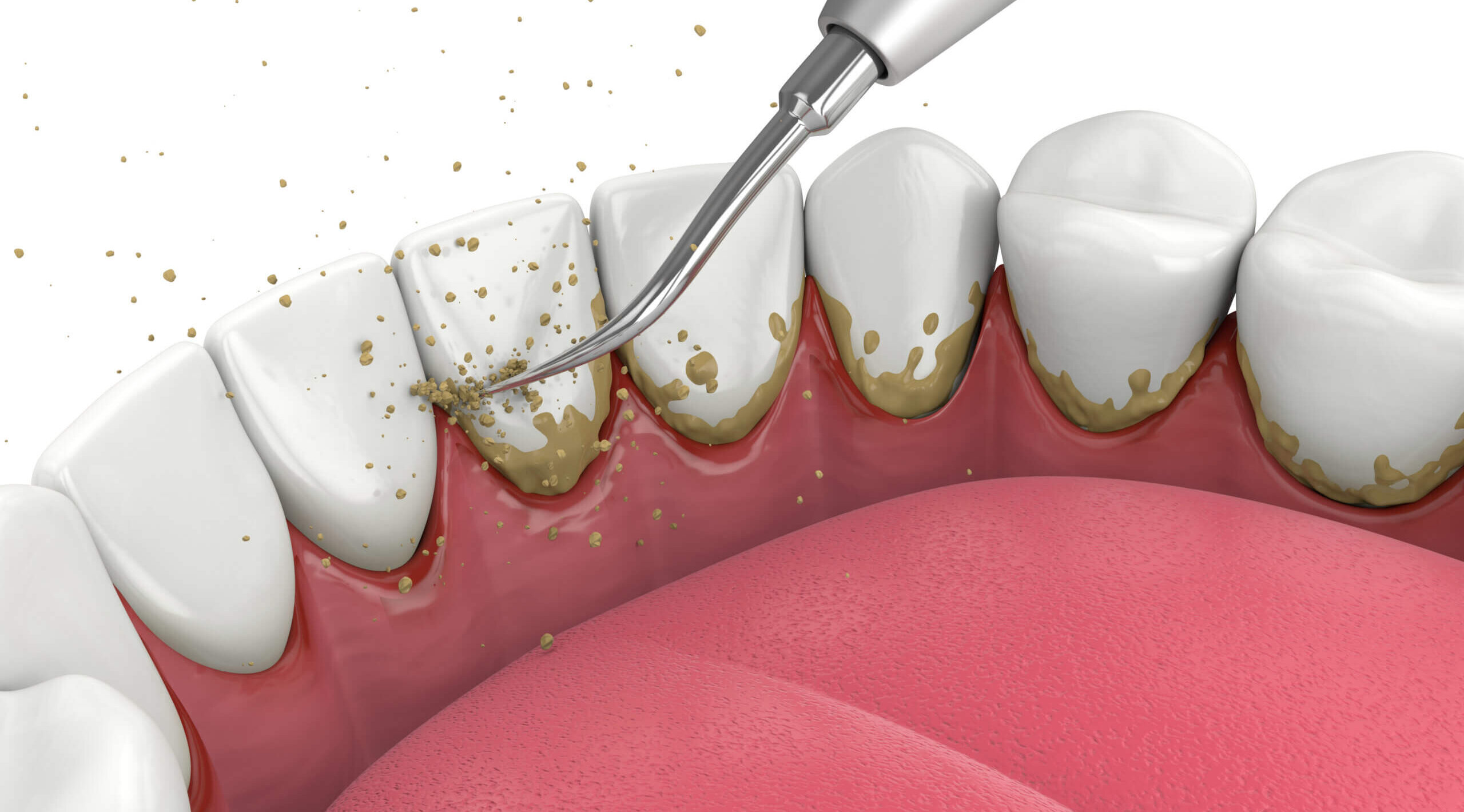 Gum Treatment in Palghar — Periodontist | Dental Solutions Palghar